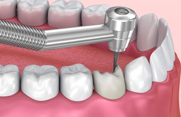 去除龋齿 医学上精确的牙3D — 图库照片