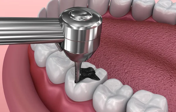 Entfernen Der Karies Medizinisch Korrekte Abbildung Der Zähne — Stockfoto