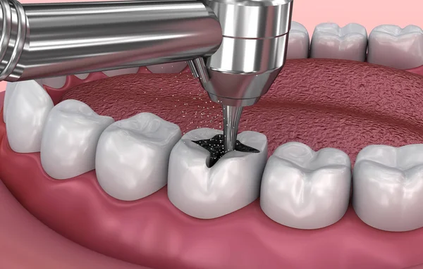 Diş Çatlak Dolgular Tıbbi Olarak Doğru Illüstrasyon — Stok fotoğraf
