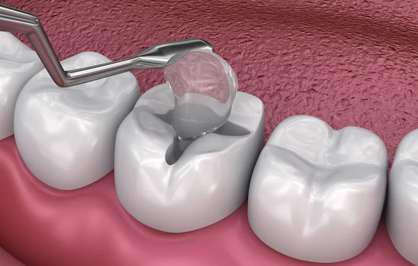 Enchimentos Fissura Dentária Ilustração Medicamente Precisa — Fotografia de Stock