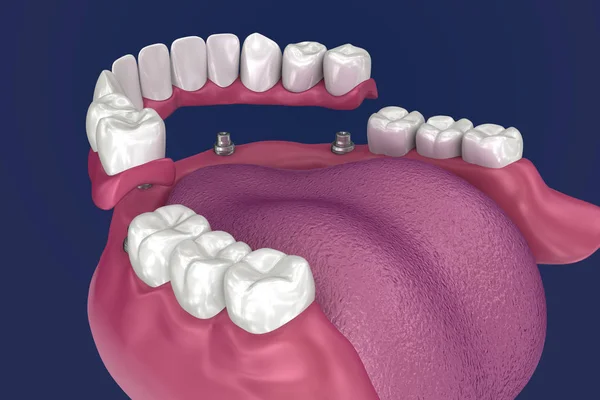 Prothèse Excessive Doit Être Assise Sur Implants Des Attaches Billes — Photo