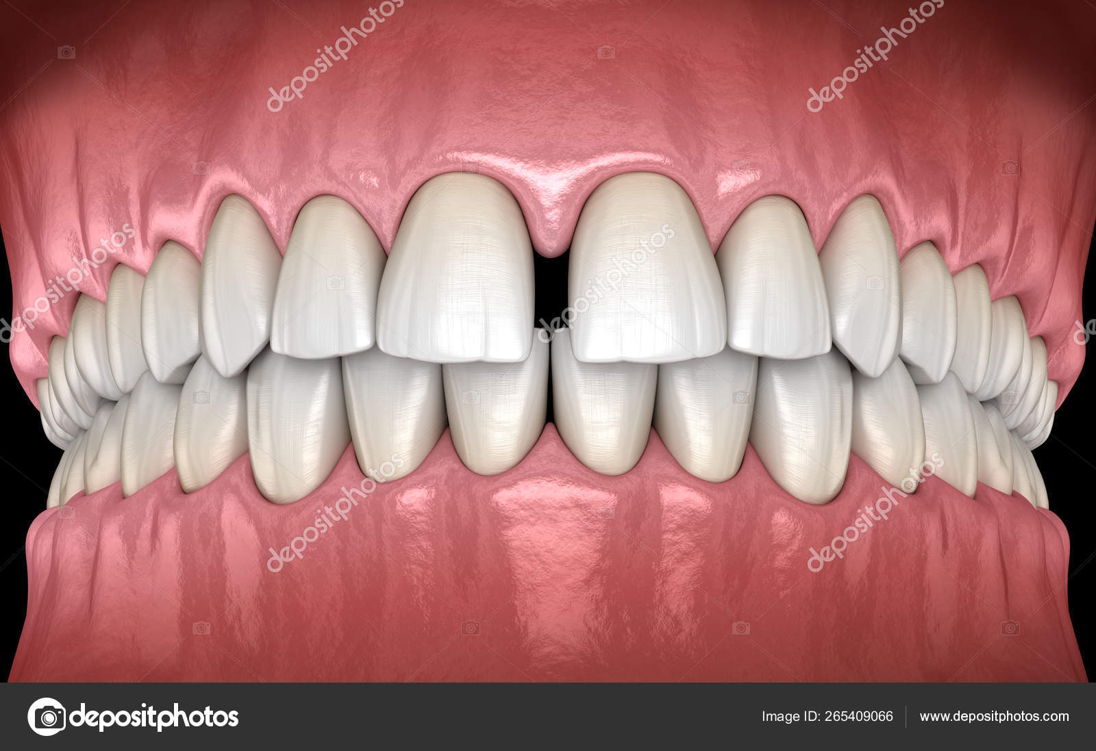 diastema central incisors teeth dental disfunction incisors