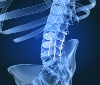 Spinal fiksasyon sistemi - titanyum braket. X-Ray 3d illüstrasyon
