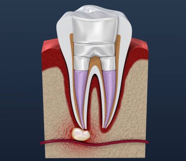 Diş dolguları prosedür diyagramı . 3d illüstrasyon
