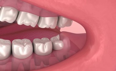 Yirmilik diş sorunu. Tıbben doğru diş 3d animasyon