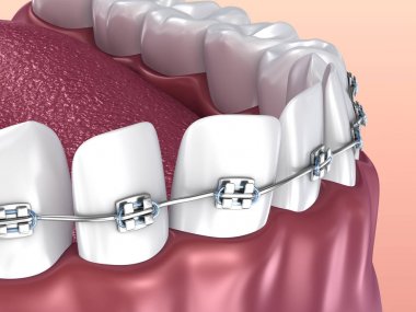 Diş telleri üzerinde beyaz izole dişli. Tıbben doğru 3d çizim