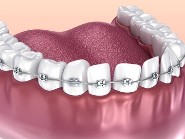 Diş telleri üzerinde beyaz izole dişli. Tıbben doğru 3d çizim