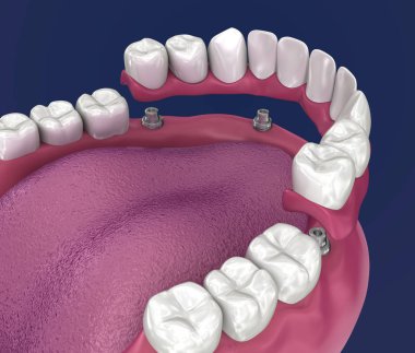 Overdenture 4 implantlar üzerinde oturacak - top ekleri. 3d illüstrasyon