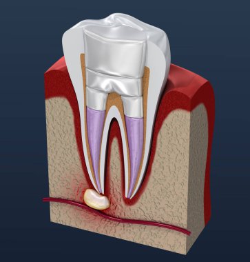 Diş dolguları prosedür diyagramı . 3d illüstrasyon
