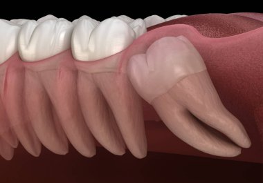 Mesial impaction ile sağlıklı dişler ve bilgelik diş . Tıbbi olarak doğru diş 3d illüstrasyon