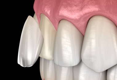 Dental Kaplama: Merkezi kesici kaplama kaplama tesisatı prosedürü. Tıbbi olarak doğru diş 3d illüstrasyon