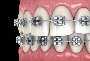 Diş etlerinde metal parantez olan dişler. Tıbbi olarak doğru diş 3d illüstrasyon