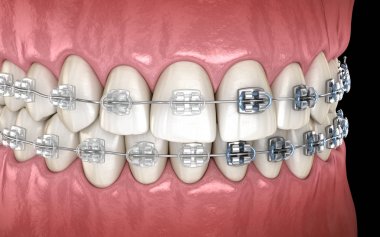 Diş etlerinde metal ve şeffaf diş telleri olan dişler. Tıbbi olarak doğru diş 3d illüstrasyon