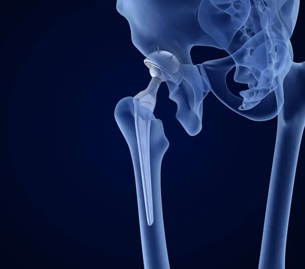 Implante Reemplazo Cadera Instalado Hueso Pelvis Vista Rayos Ilustración Médicamente — Foto de Stock