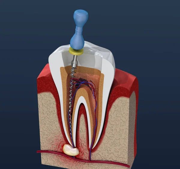 Root Canal Treatment Process Illustration — Stock Photo, Image