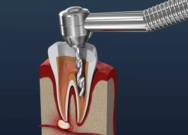 Wurzelkanalbehandlung Illustration — Stockfoto