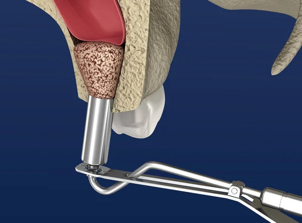 Sinus Lift Chirurgie Sinus Augmentation Illustration — Stockfoto