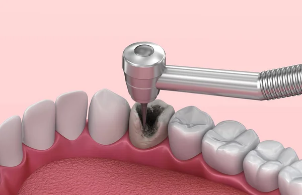 Removing the caries . Medically accurate tooth 3D illustration