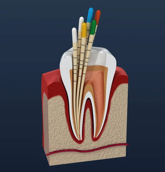 Gutta Gutaperča Endodoncii Zubní Anatomie Ilustrace — Stock fotografie