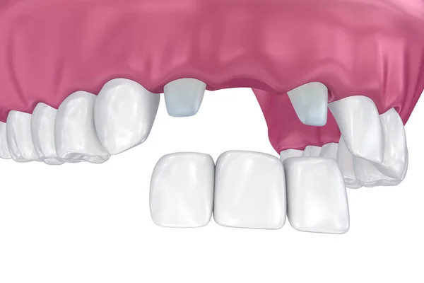歯には 固定ブリッジがサポートされています 医学的に正確な イラスト — ストック写真