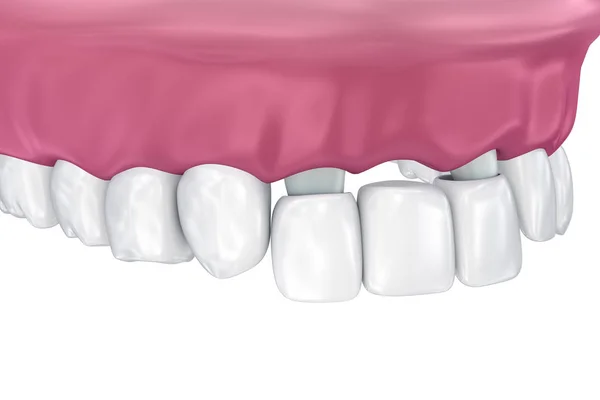 歯には 固定ブリッジがサポートされています 医学的に正確な イラスト — ストック写真
