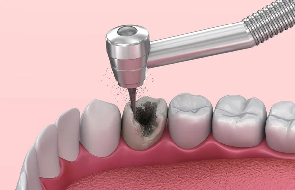 Removing Caries Medically Accurate Tooth Illustration — Stock Photo, Image