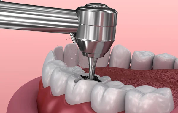 Removing the caries . Medically accurate tooth 3D illustration