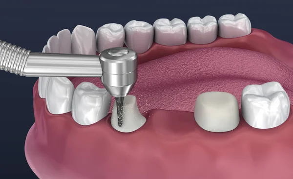 Dent Soutenu Pont Fixe Dents Illustration Médicalement Précise — Photo