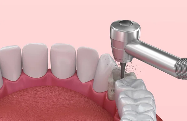 去除龋齿 医学上精确的牙3D — 图库照片