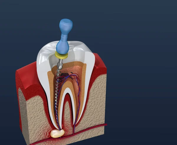 Root Canal Treatment Process Illustration — Stock Photo, Image