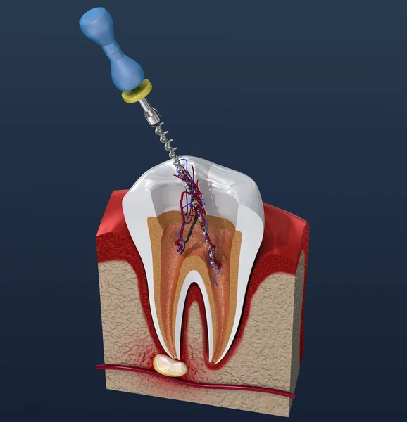 Root canal treatment process. 3D illustration