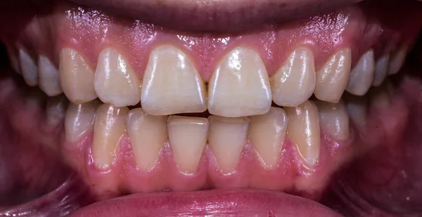 Healthy human teeth with normal occlusion from frontal view