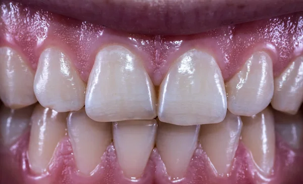 Healthy human teeth with normal occlusion from frontal view