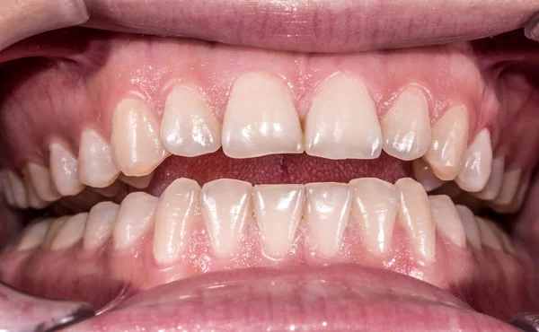 Frontal intraoral görünümden normal oklüzyon ile sağlıklı insan dişleri