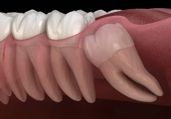 健康な歯と知恵の歯は メシアルな衝動を持つ 医学的に正確な歯3Dイラスト — ストック写真