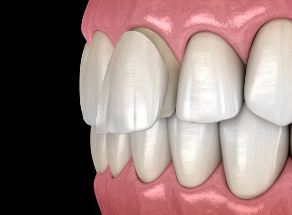 Dentale Fineer Centrale Snijtanden Fineer Installatie Procedure Medisch Nauwkeurige Tand — Stockfoto