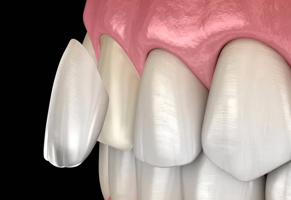 歯科ベニヤ 中央切開器ベニヤの取付け手順 医学的に正確な歯3Dイラスト — ストック写真