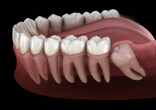 Dentes Saudáveis Dentes Sábios Com Impacto Mesial Ilustração Dente Medicamente — Fotografia de Stock