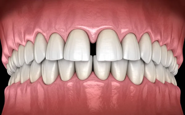 中央门牙的乳突 牙科功能障碍3D图解概念 — 图库照片