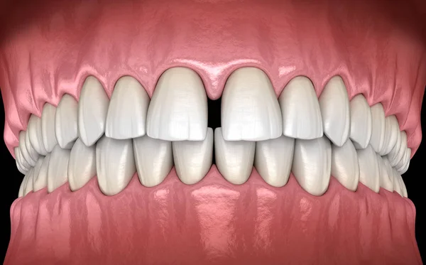 Diastema Dientes Incisivos Centrales Disfunción Dental Concepto Ilustración — Foto de Stock