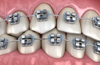 Diş etlerinde metal parantez olan dişler. Tıbbi olarak doğru diş 3d illüstrasyon