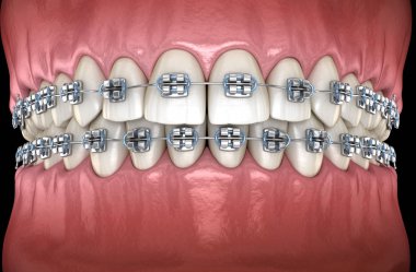 Diş etlerinde metal parantez olan dişler. Tıbbi olarak doğru diş 3d illüstrasyon