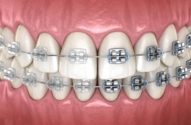 Diş etlerinde metal ve şeffaf diş telleri olan dişler. Tıbbi olarak doğru diş 3d illüstrasyon