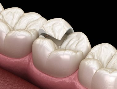 Onlay ceramic crown fixation over tooth. Medically accurate 3D illustration of human teeth treatment clipart