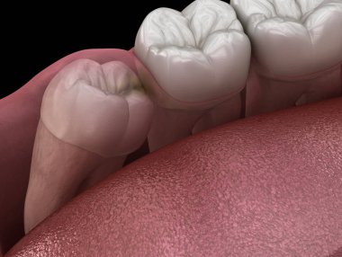 Mesial impaction ile sağlıklı dişler ve bilgelik diş . Tıbbi olarak doğru diş 3d illüstrasyon
