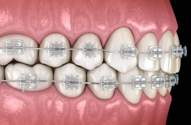 Diş etlerinde diş telleri temizleyin. Tıbbi olarak doğru diş 3d illüstrasyon