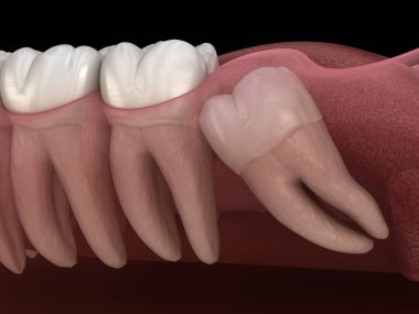 Mesial impaction ile sağlıklı dişler ve bilgelik diş . Tıbbi olarak doğru diş 3d illüstrasyon