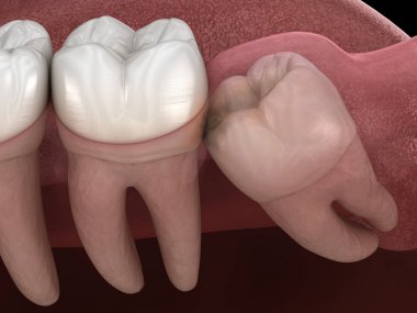 Mesial impaction ile sağlıklı dişler ve bilgelik diş . Tıbbi olarak doğru diş 3d illüstrasyon