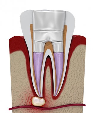 Diş dolguları prosedür diyagramı . 3d illüstrasyon
