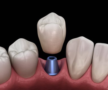 İmplant ayağının üzerine azı dişi yerleştirilmiş. İnsan dişleri ve protez kavramının tıbben doğru üç boyutlu çizimi